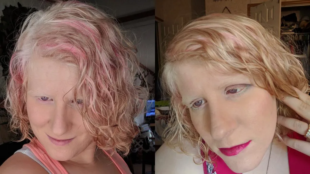 can people with albinism dye their hair