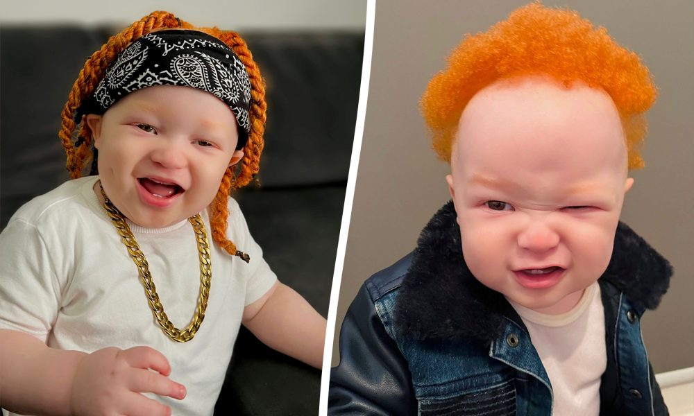 can people with albinism dye their hair