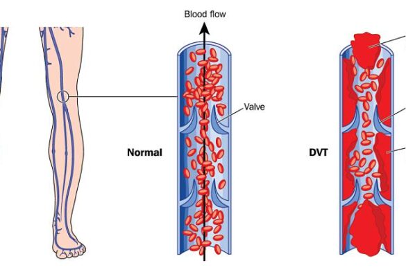 Modern Approaches to Preventing Deep Vein Thrombosis During Travel