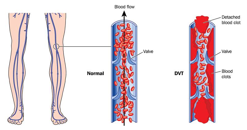 Modern Approaches to Preventing Deep Vein Thrombosis During Travel