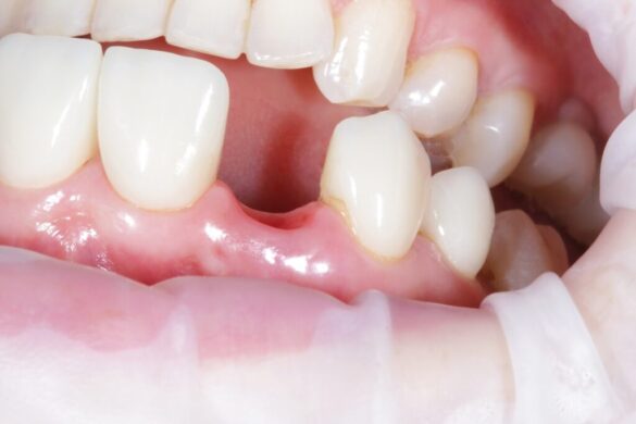 What Happens If You Don’t Replace a Missing Tooth? covers shifting teeth, bone loss, bite problems, and long-term impacts on oral health.