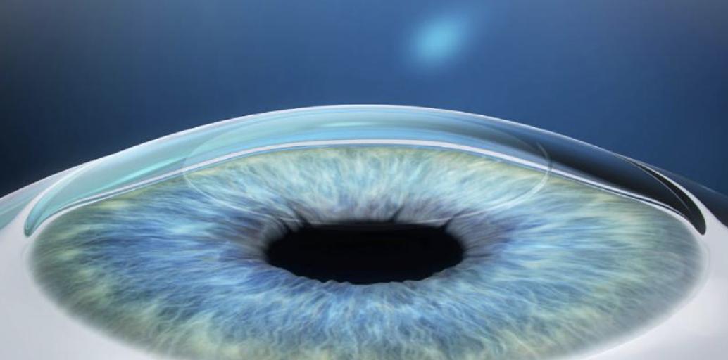 Lasik Eye Surgery in NYC