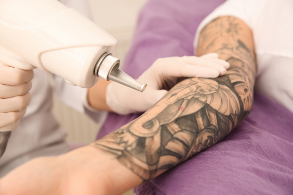 Tattoo Fading vs. Removal: What’s the Difference