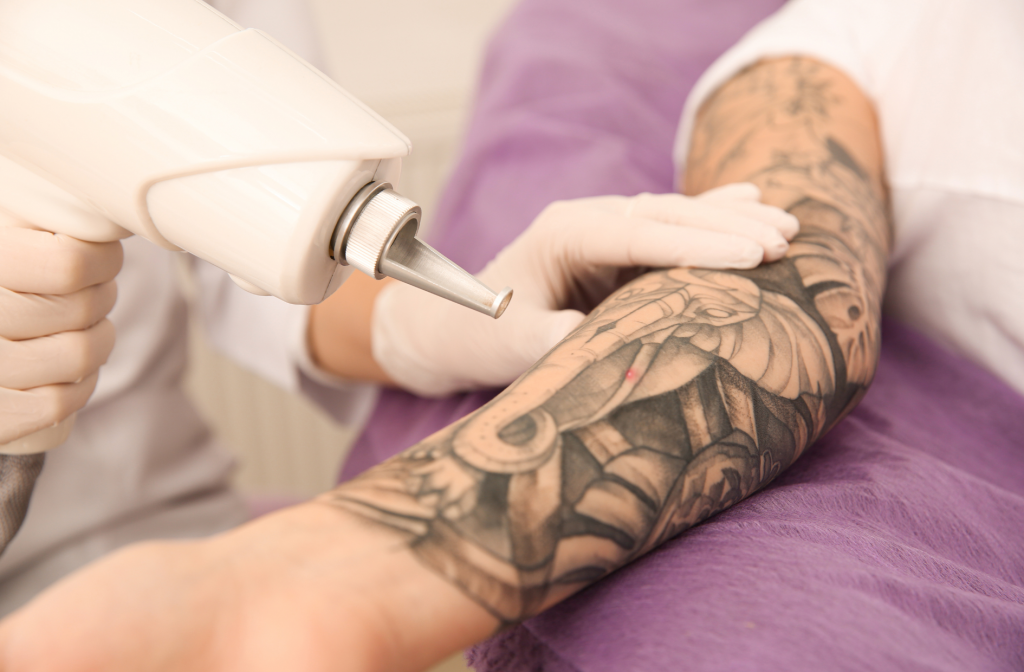 Tattoo Fading vs. Removal: What’s the Difference