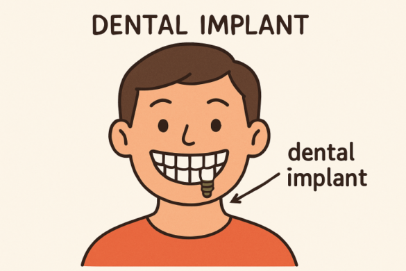 Dental Implants